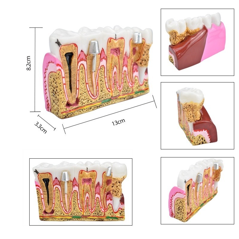 Dental Caries Anatomy Comprehensive Pathology Tooth Nerve Tooth Model ...