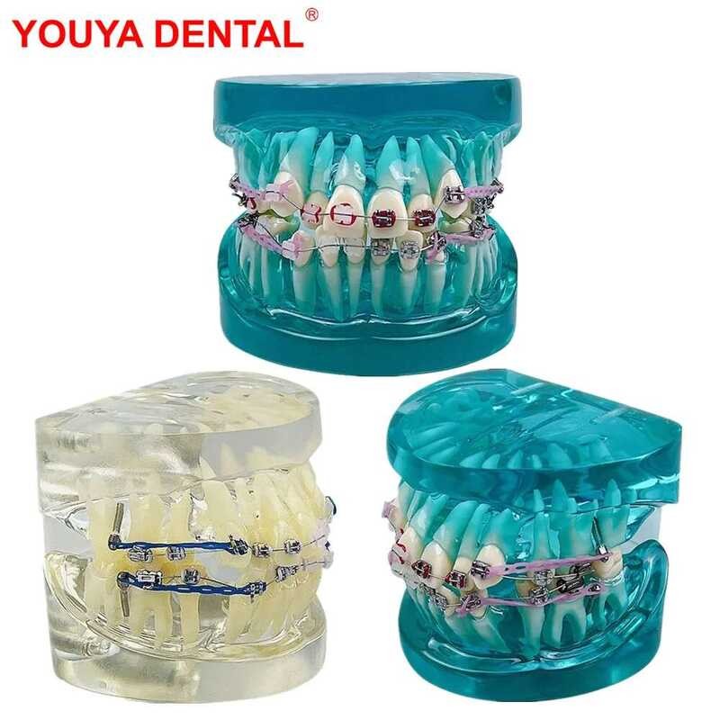 Orthodontic Dental Teeth Model With Braces Half Metal Half Ceramic ...