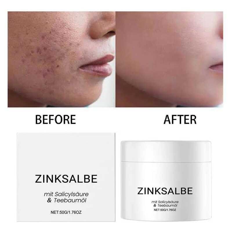 10 Best Blackhead Remover Treatments for Clearer Pores | Allure