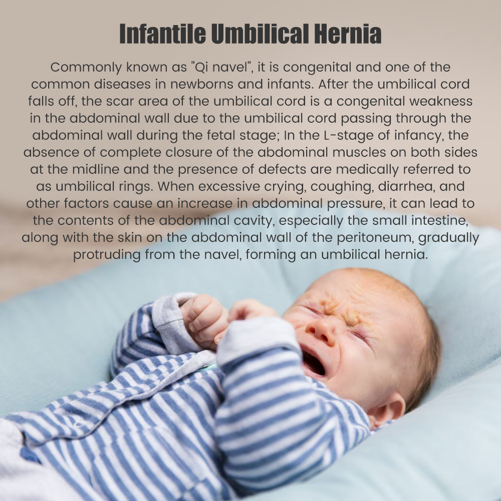 Salorie Infant Inguinal Umbilical Hernia Belt Navel Support Stickers