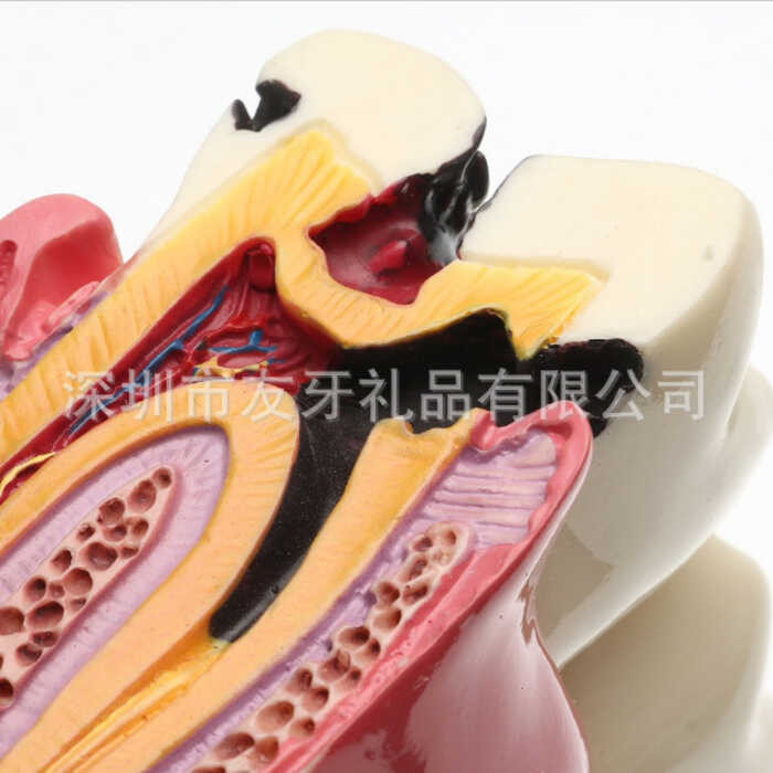 Tooth Model 6X Caries Comparison Model Oral Model Ching Model Dental ...