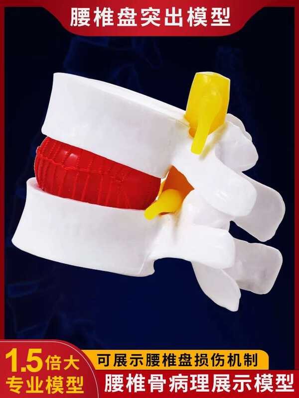 Medical enlarged human lumbar disc compression demonstration model ...