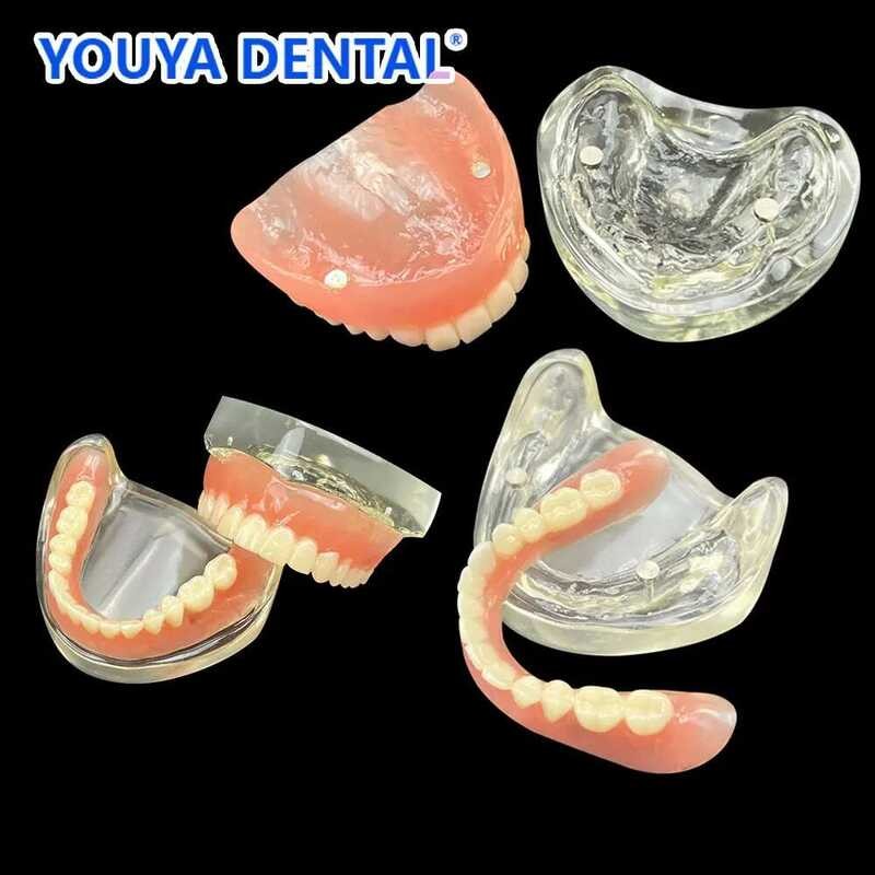 2 Implant Upper Lower Jaw Models Dental Model Teeth Removable Bridge ...