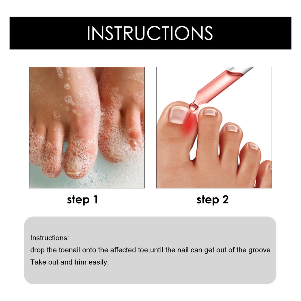 10ml/30ml Ingrown Toenail Ingrown Toenail Pain Relief And Softener Kit ...