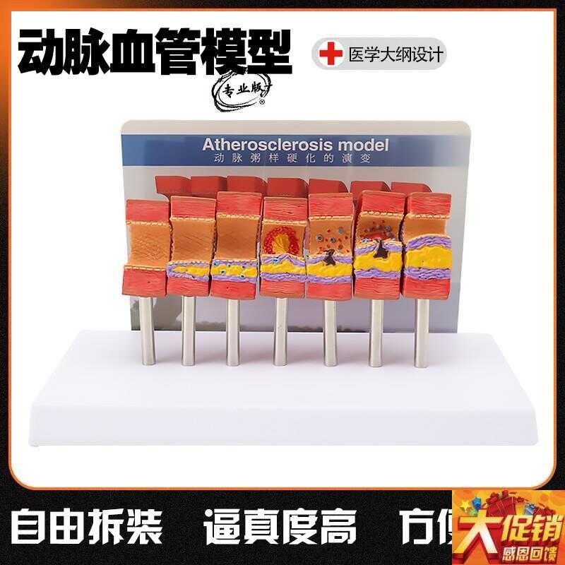 Human vascular pathological anatomy model Human vascular structure ...