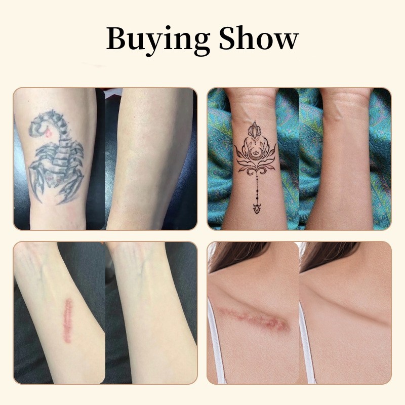 Tattoo Cover Up Patch Ultra Thin Patch for Tattoo Scar and Birthmarks ...