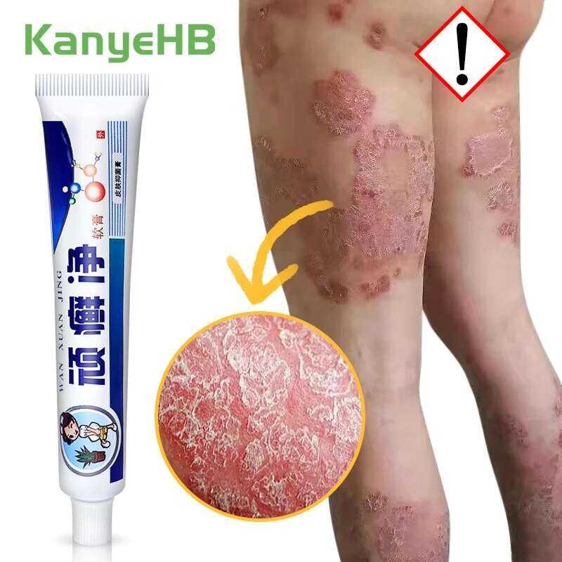 Skin 1Pcs Psoriasis Cream 100% Original Herbal Plaster Dermatitis ...