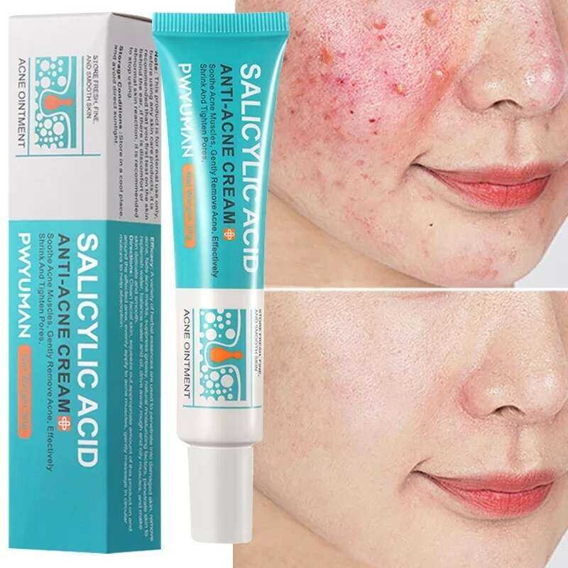 Acne Removal Cream For Acne On Hips