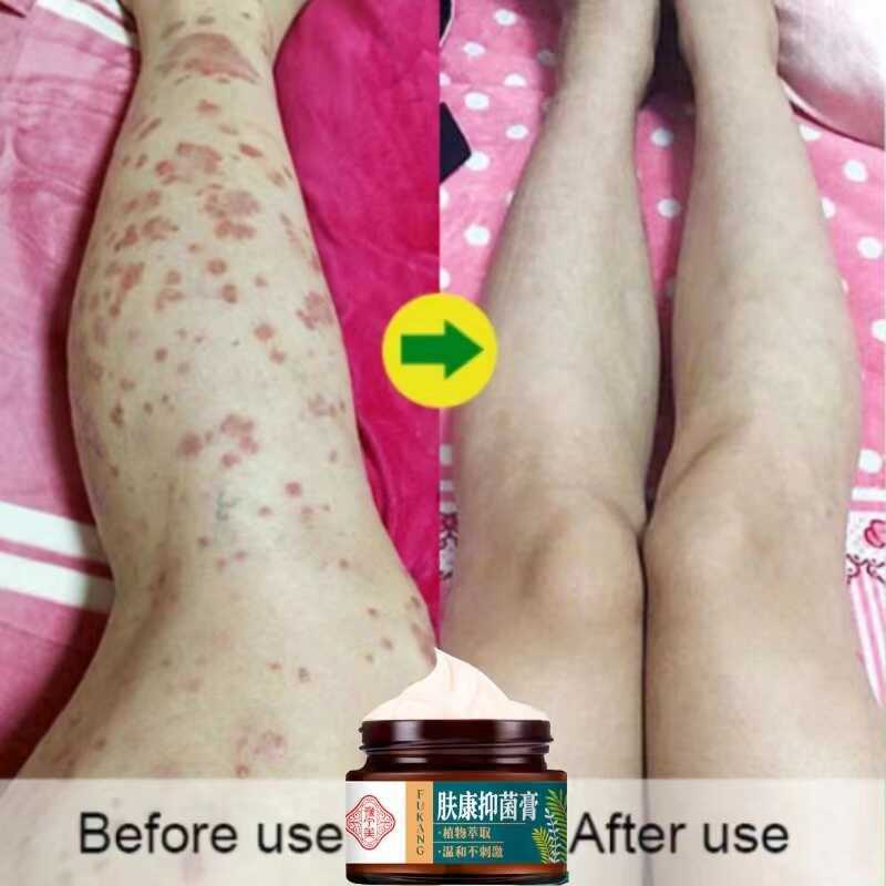 daifu Chinese Herbal Skin Psoriasis Cream Dermatitis Eczematoid Eczema ...