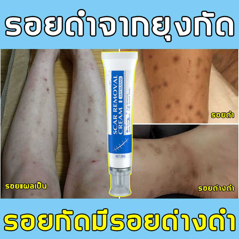 COD Scar Cream 30g Grams Reduces Acne Removes Scars from Mosquito Bites ...