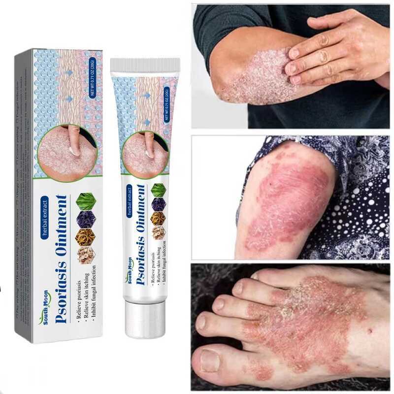 A0 South Moon Gamot Sa Kati Balat Herbal Psoriasis Dermatitis Eczema ...