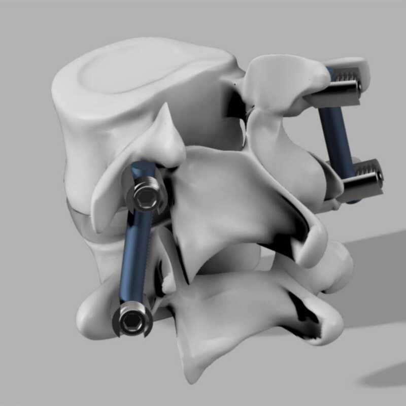 Spinal Fixation Vertebral Root Screws System STEP Model 3D Drawing ...