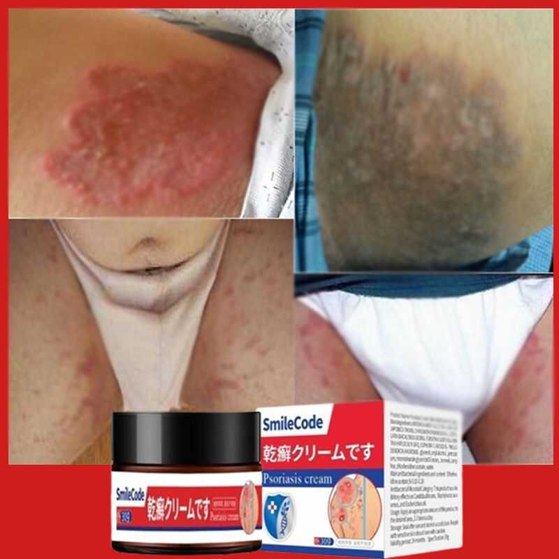 2F28 9400 100% Effectivejapanese Psoriasis Eczema Fungal Fungisol ...