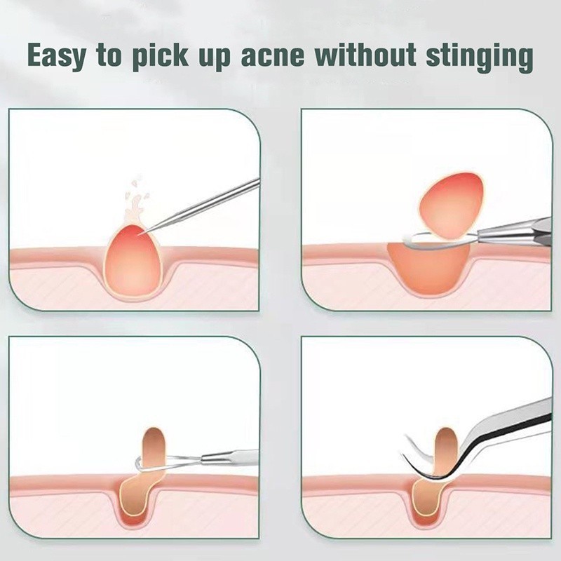 7-IN-1 Acne and Blackhead Extraction Kit Stainless Steel Acne Clip Cell ...