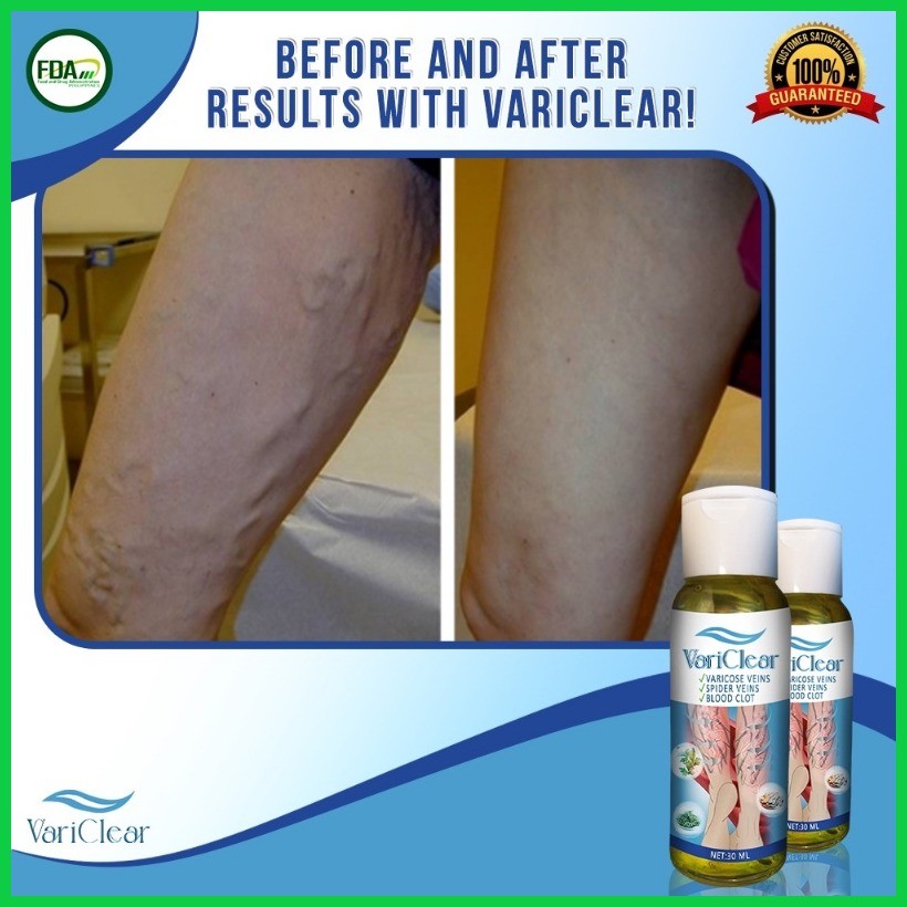 VariClear - VARICOSE VEINS, SPIDER VEINS, BLOOD CLOT | Shopee Philippines