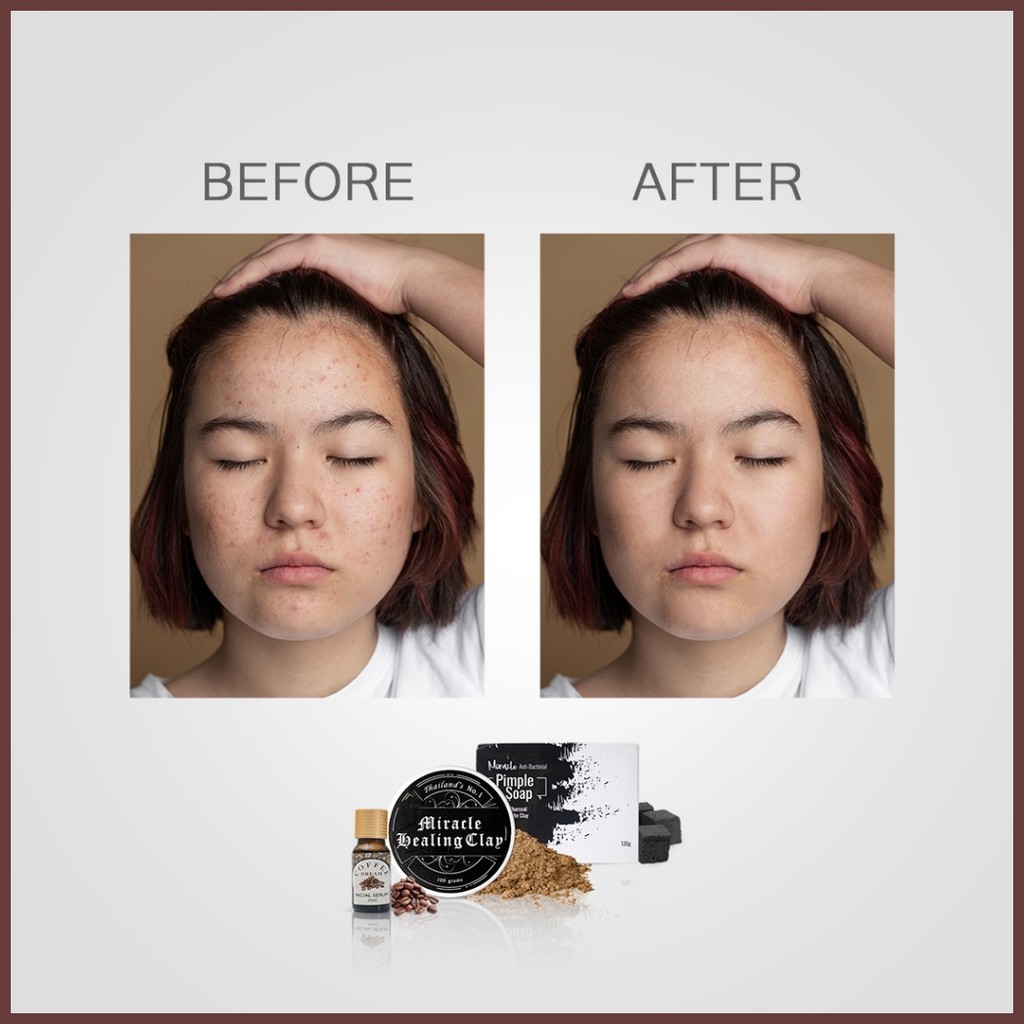 ⌚ Miracle Set - Acne Starter Kit / Blemish Miracle Set - Coffee Serum ...