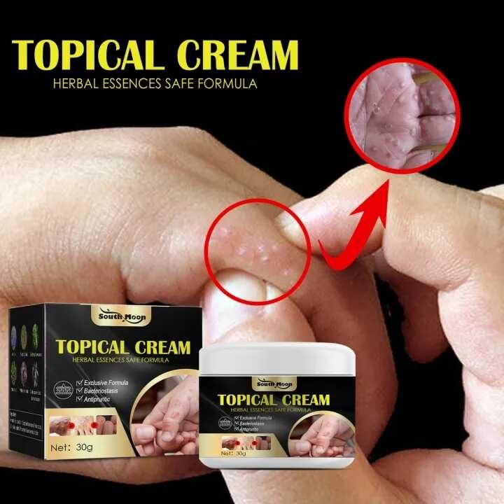 COD Anti Allergy And Inflammatory TOPICAL CREAM Eczema Treatment ...