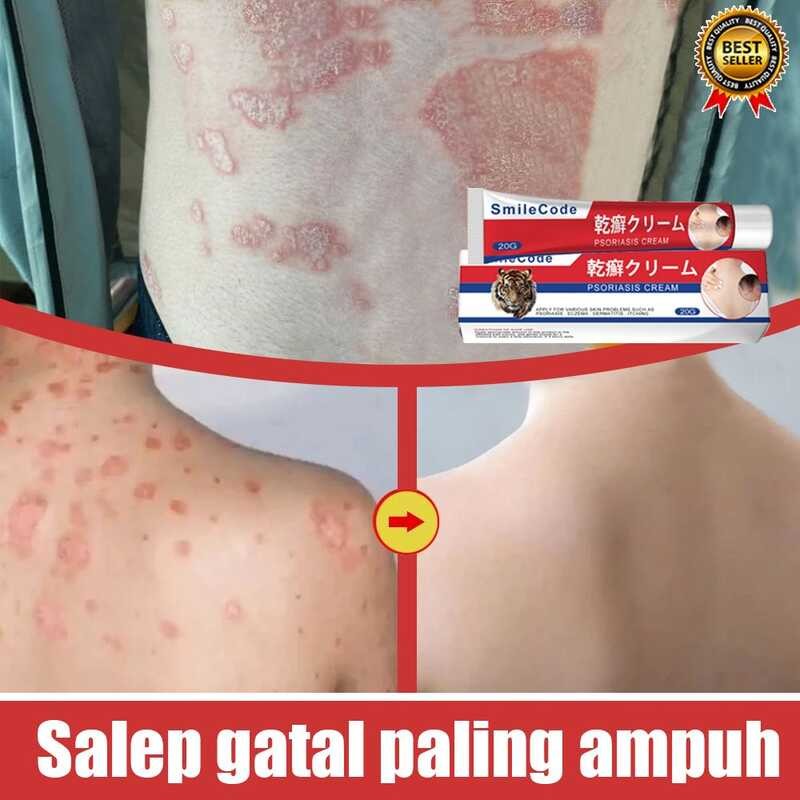And Acne Freckle Removal Japanese Psoriasis 20G Eczema Fungal Fungisol ...
