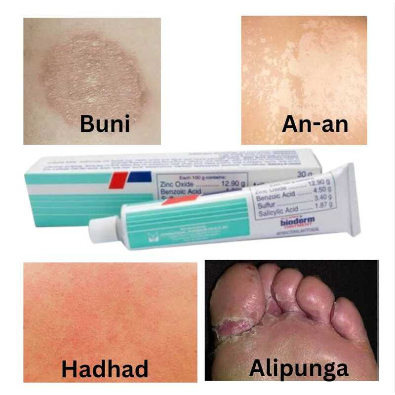 Anti-Fungal Ointment, Mabisa Sa An-An, Hadhad, Buni At Alipunga 15G 409 ...