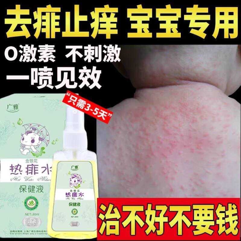 Itch Relief Spray Liquid, Ointment, Rash Treatment, Prickly Water for ...