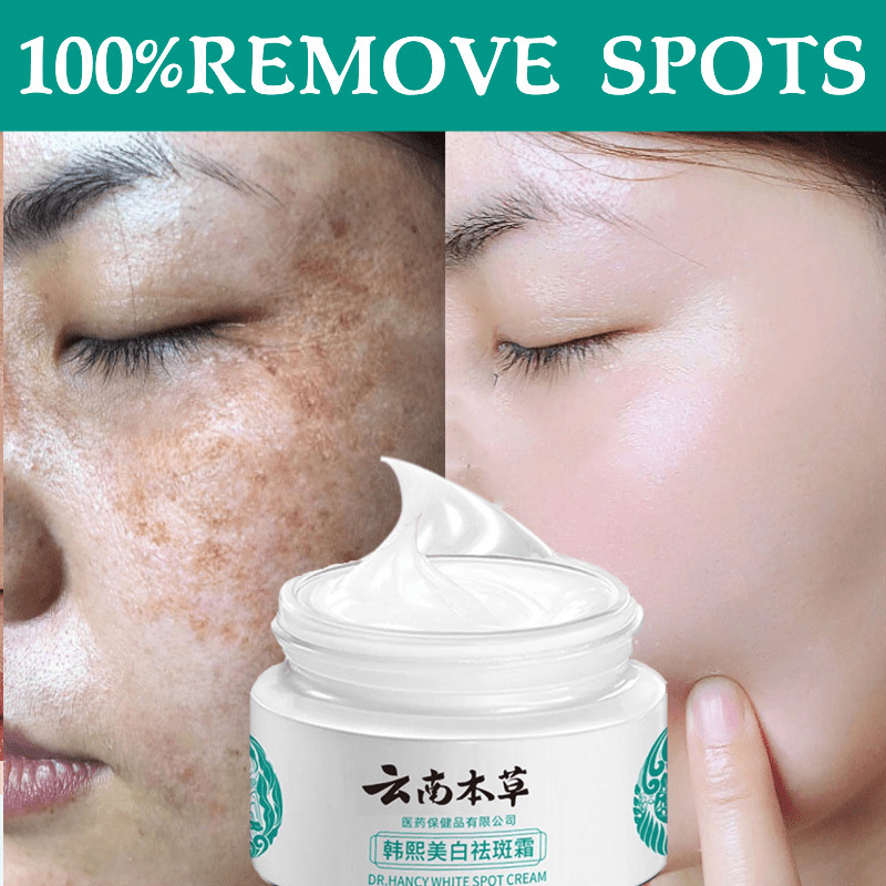 Natnat pekas melasma cream Japanese melasma cream original melasma ...