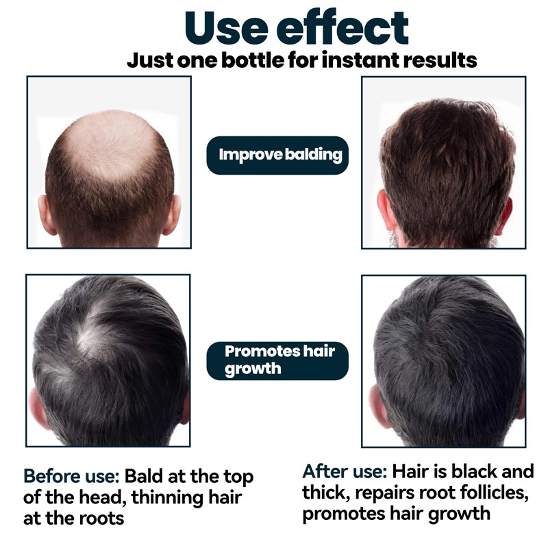 Men's Hair Growth Serum Hair Nutrition Care Anti-Hair Loss Dense ... - Hair Growth Serum For Men With Uneven Hair Growth Pattern And Loss