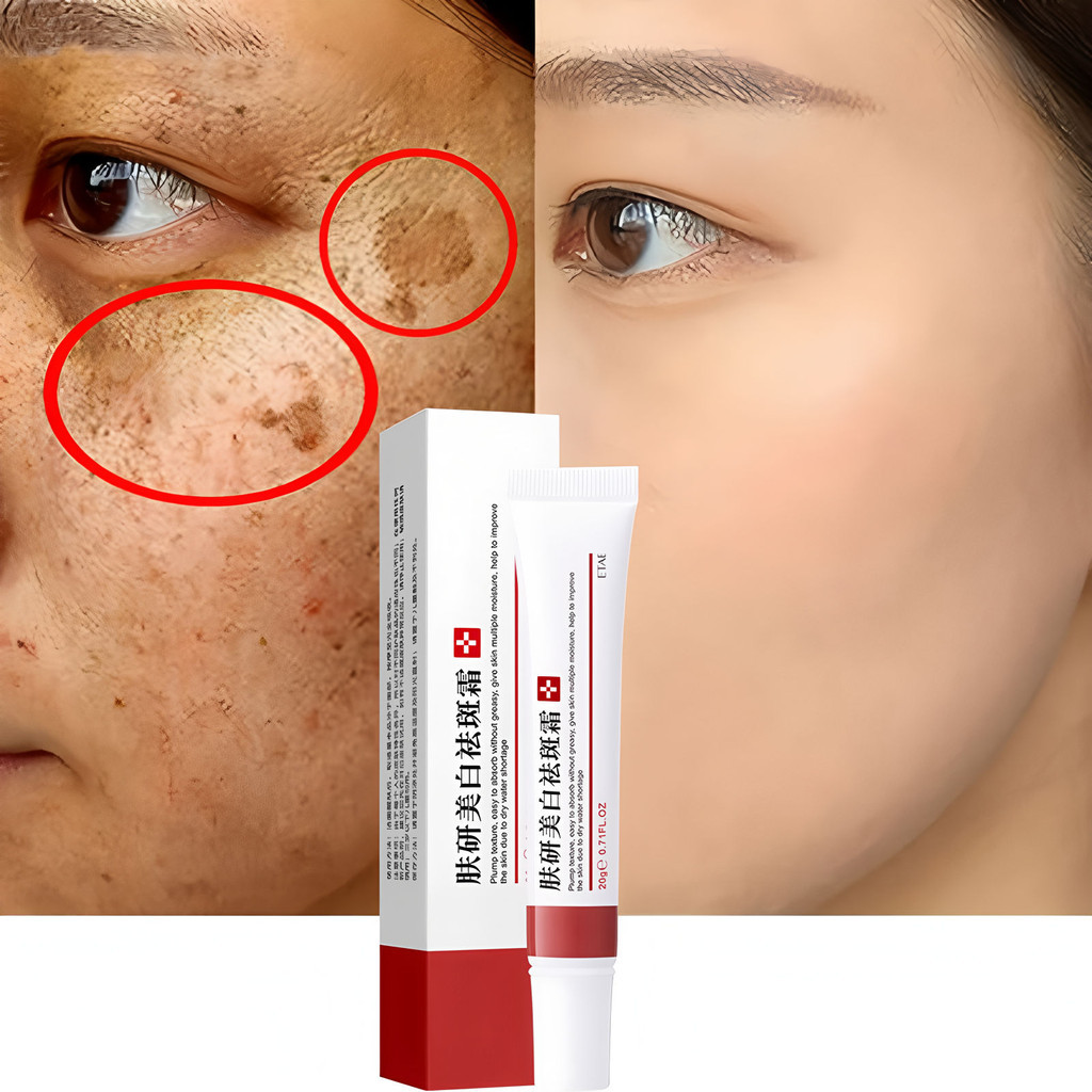 Freckle Cream, Acne Scar Removal Cream, Pigmentation Removal Cream for ...