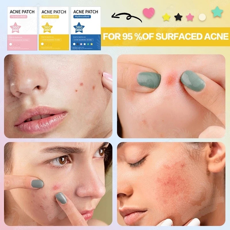 Acne Pimples Patches Hydrocolloid Colorful Suitable All Skin Mild Non ...