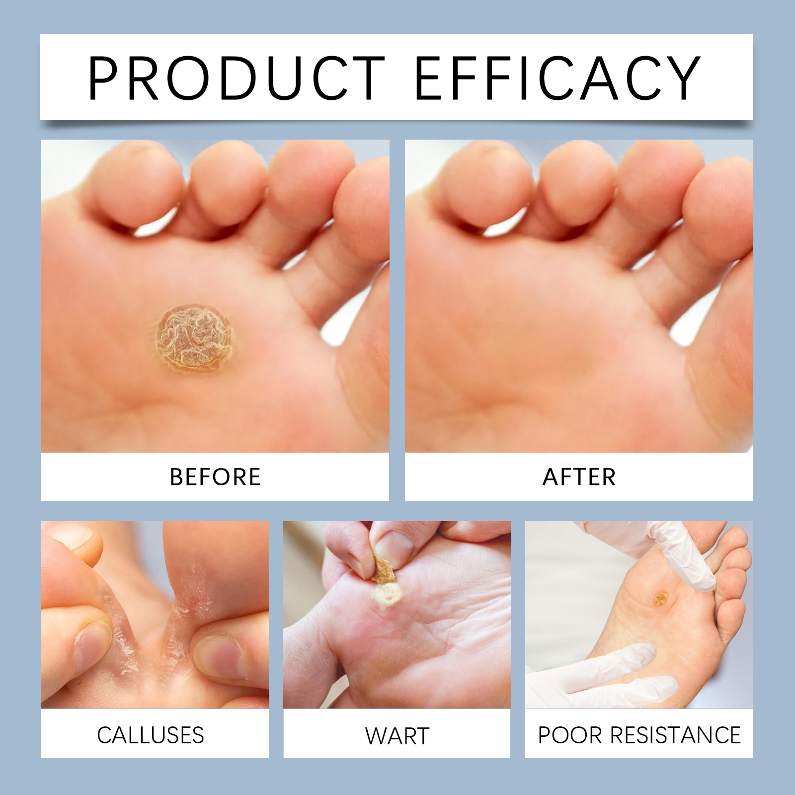 24PCS Foot Corns Remover Patch Warts Remover Pads Remove Calluses Feet ...