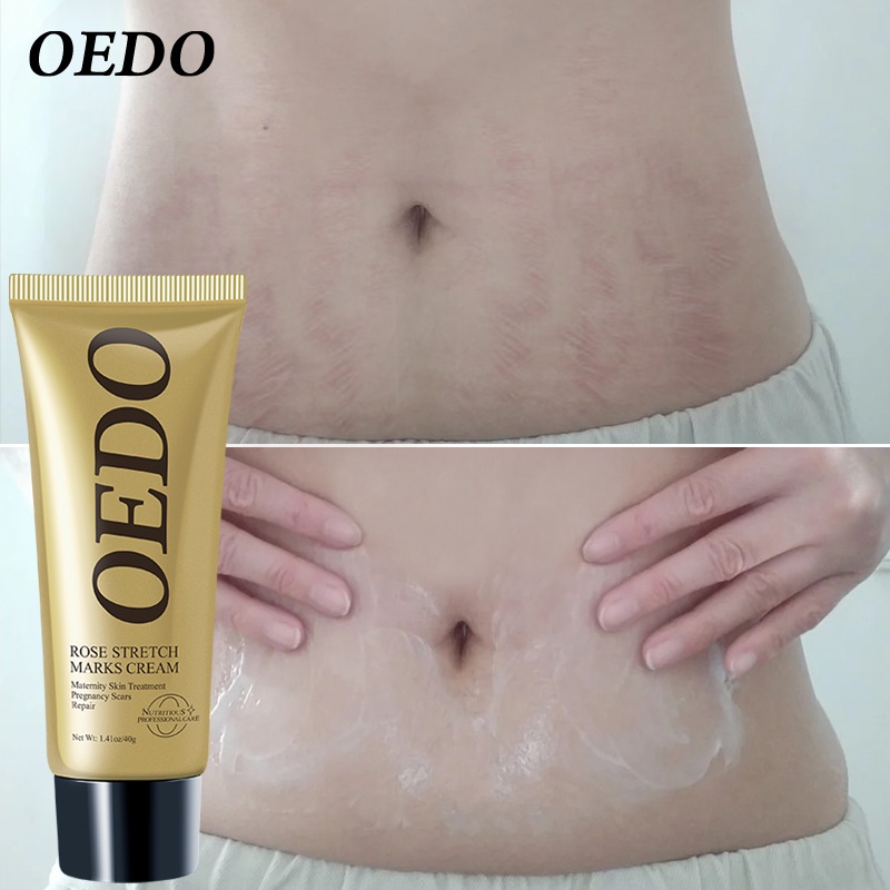 cara menggunakan oedo rose remove stretch mark cream