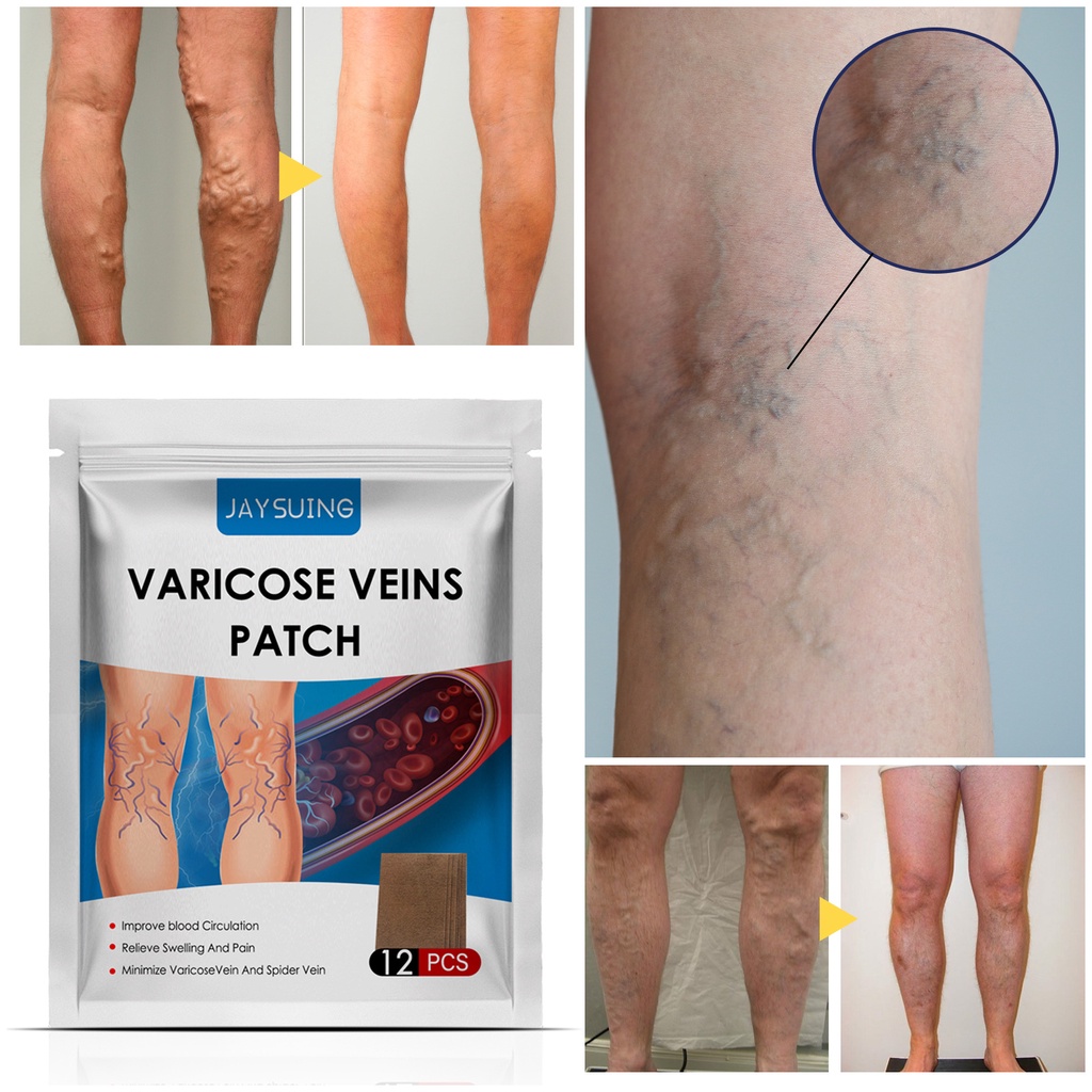 Jaysuing Varicose Veins Patch Intravenous Remover Patch Varicose Vein ...