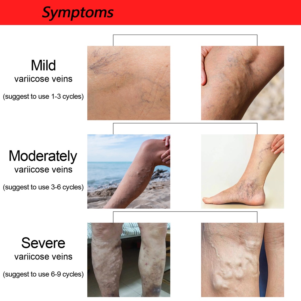 Jaysuing Varicose Veins Patch Intravenous Remover Patch Varicose Vein ...