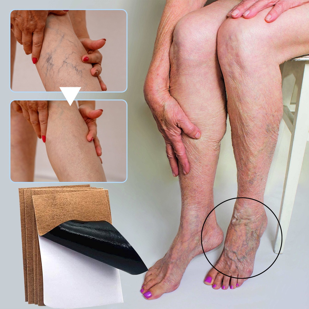 Jaysuing Varicose Veins Patch Intravenous Remover Patch Varicose Vein ...