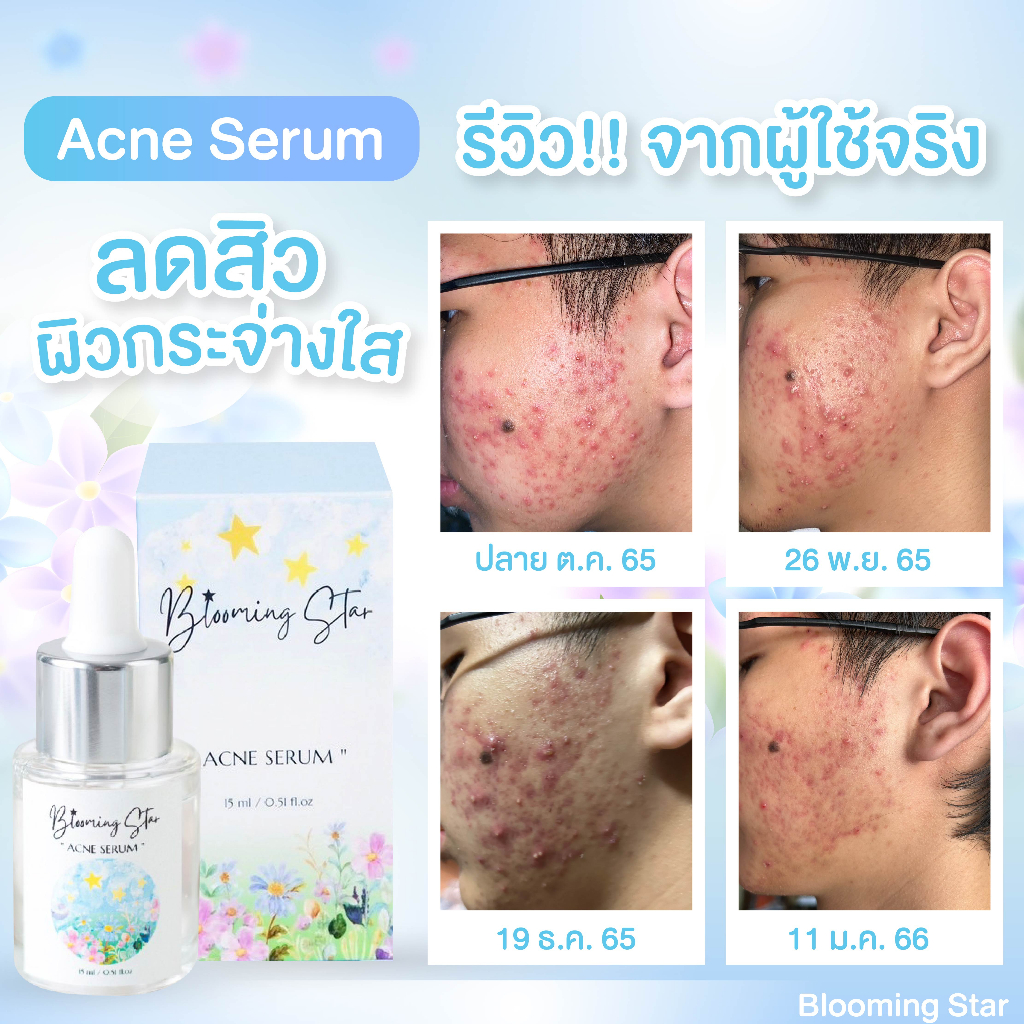 Photo inspiration: Gallery Detail: Acne Heals Without Serum Reduce Inflammation Of Collapse Kill Bacteria