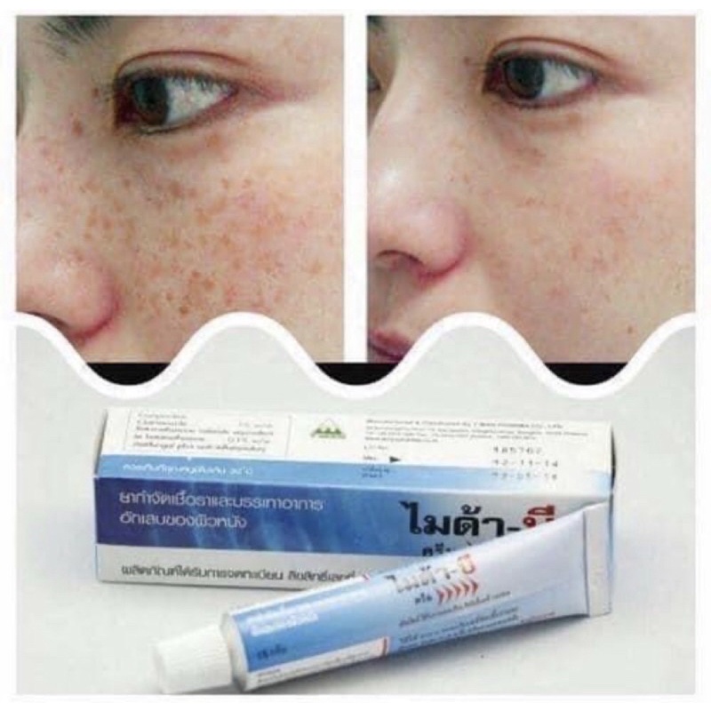 Myda-b Tube Of Melasma Cream 15g Thailand | Shopee Philippines