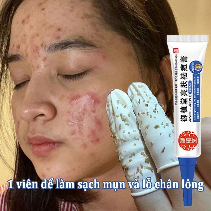 8 Best Over-the-Counter Acne Treatments, According to a Pharmacist