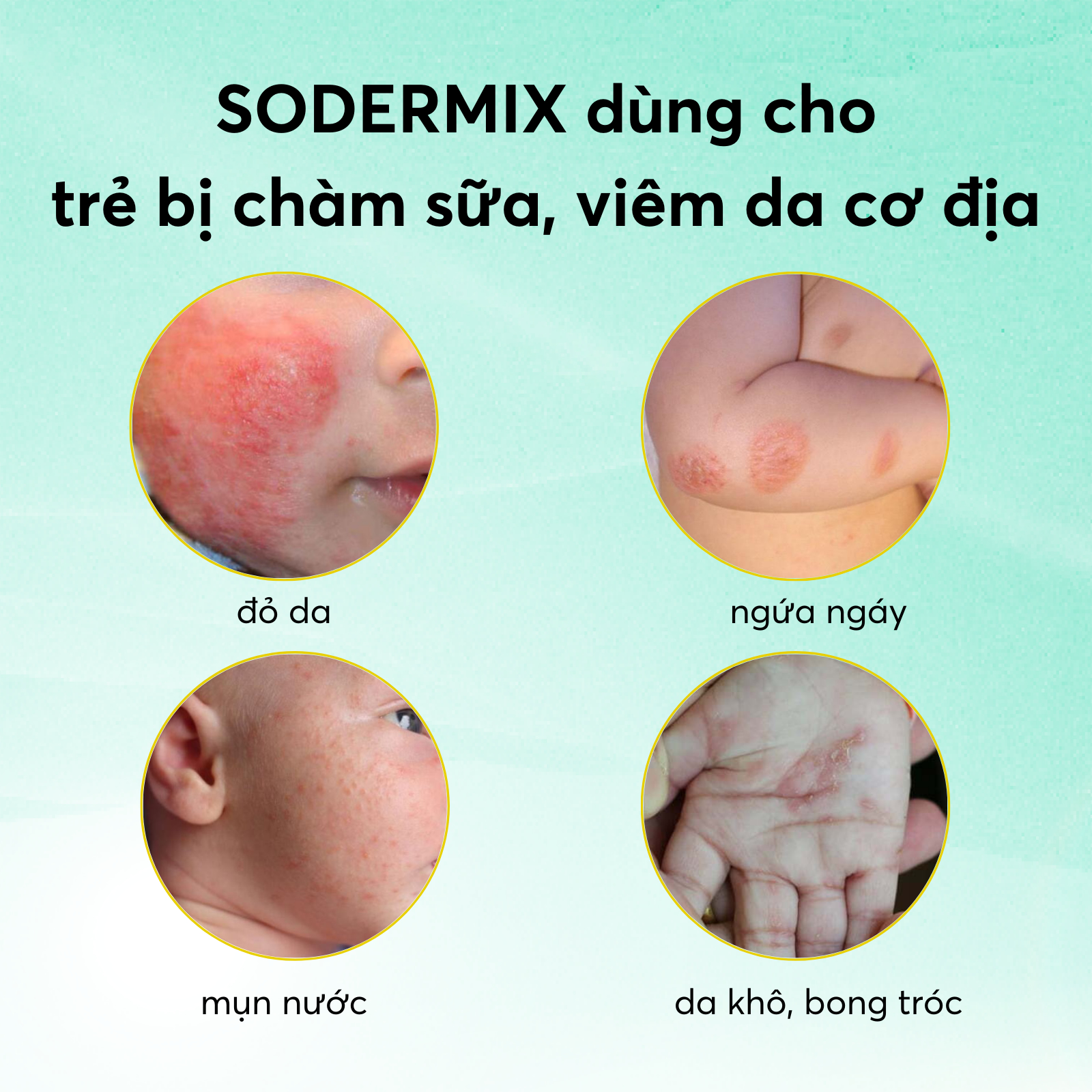 [Free Pink Cloud] SODERMIX Milk Eczema Cream 30g Helps Reduce Itching ...